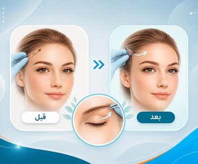 عکس های قبل و بعد لیفت شقیقه