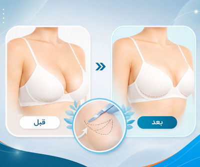 عکس های قبل و بعد ماموپلاستی